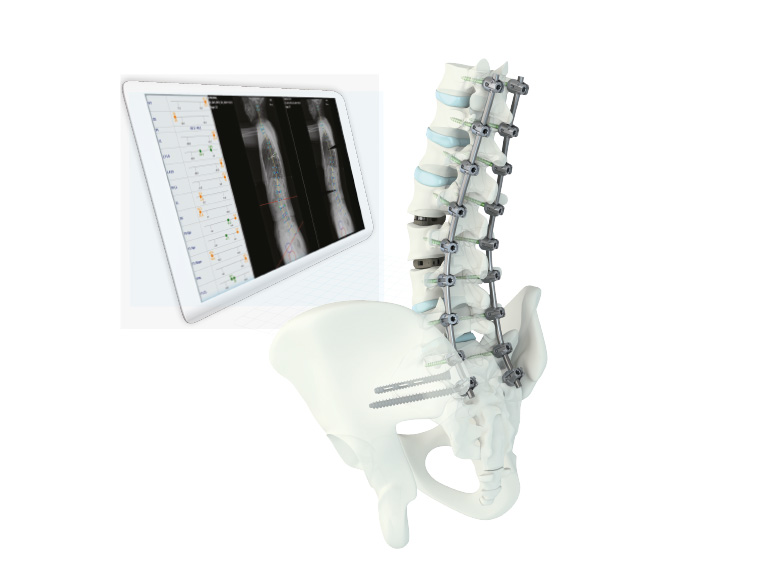 MySpine Optimizer